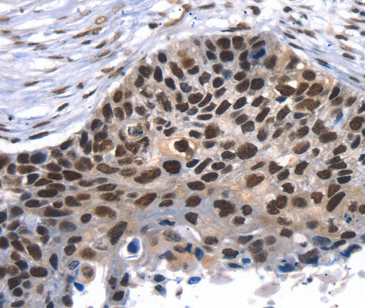 Immunohistochemistry of paraffin-embedded Human esophagus cancer using TAF15 Polyclonal Antibody at dilution of 1:35