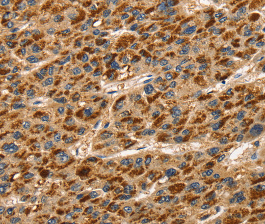 Immunohistochemistry of paraffin-embedded Human liver cancer using TLN1 Polyclonal Antibody at dilution of 1:30