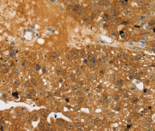 Immunohistochemistry of paraffin-embedded Human breast cancer using TBC1D4 Polyclonal Antibody at dilution of 1:40