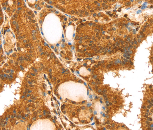 Immunohistochemistry of paraffin-embedded Human thyroid cancer tissue using TRIM25 Polyclonal Antibody at dilution 1:40