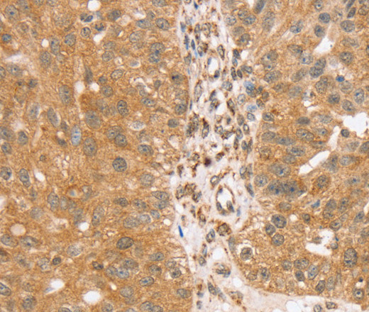 Immunohistochemistry of paraffin-embedded Human breast cancer tissue using TRIM25 Polyclonal Antibody at dilution 1:40