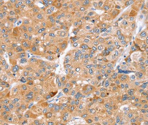 Immunohistochemistry of paraffin-embedded Human liver cancer using ZFP36L2 Polyclonal Antibody at dilution of 1:45