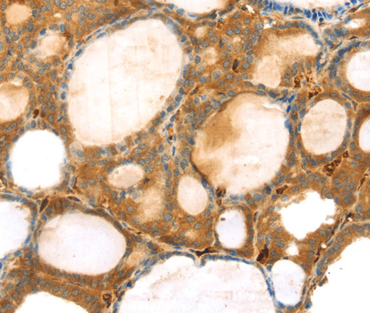 Immunohistochemistry of paraffin-embedded Human thyroid cancer using TMPRSS11F Polyclonal Antibody at dilution of 1:30