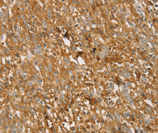 Immunohistochemistry of paraffin-embedded Human gastric cancer using TMPRSS11F Polyclonal Antibody at dilution of 1:30