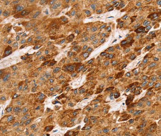 Immunohistochemistry of paraffin-embedded Human liver cancer tissue using LTB Polyclonal Antibody at dilution 1:45