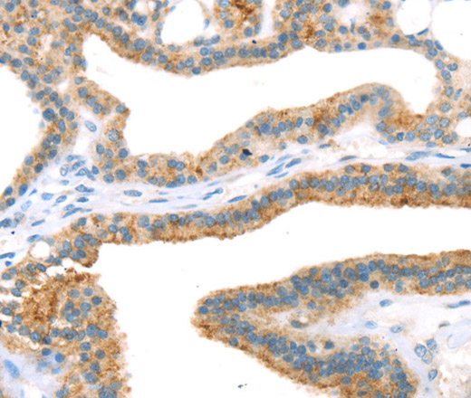 Immunohistochemistry of paraffin-embedded Human thyroid cancer using TNIP2 Polyclonal Antibody at dilution of 1:35