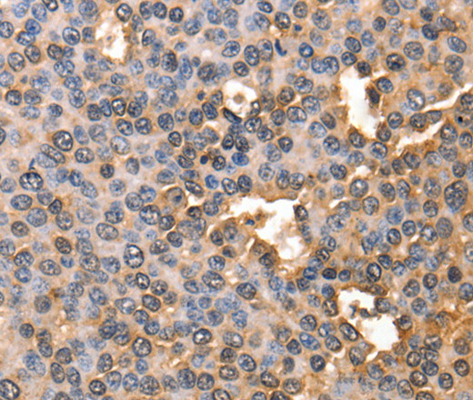 Immunohistochemistry of paraffin-embedded Human liver cancer using AFP Polyclonal Antibody at dilution of 1:60