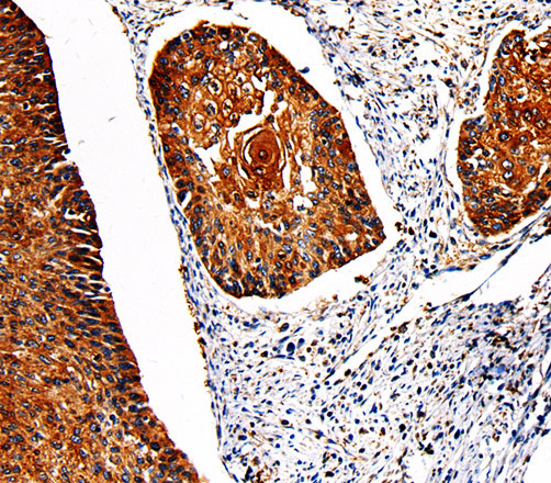 Immunohistochemistry of paraffin-embedded Human cervical cancer using PKM Polyclonal Antibody at dilution of 1:50