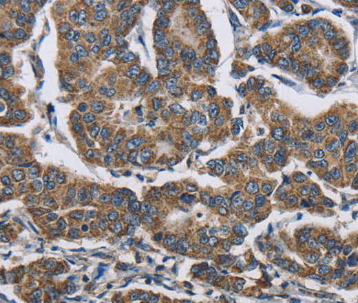 Immunohistochemistry of paraffin-embedded Human breast cancer using RAGE Polyclonal Antibody at dilution of 1:70