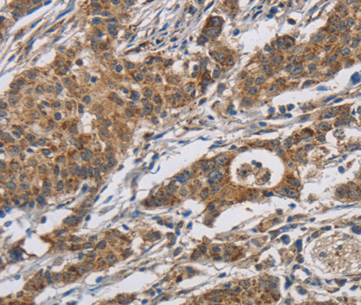 Immunohistochemistry of paraffin-embedded Human gastric cancer using RAGE Polyclonal Antibody at dilution of 1:70