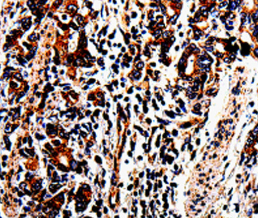 Immunohistochemistry of paraffin-embedded Human stomach cancer tissue using ACSBG2 Polyclonal Antibody at dilution 1:60