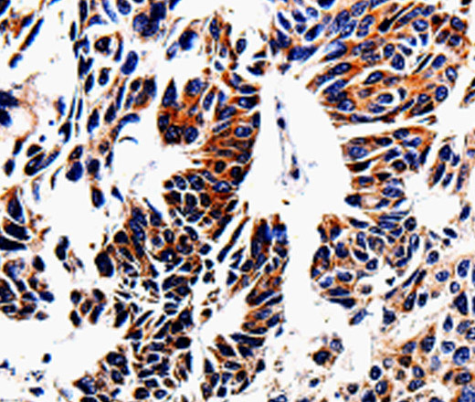 Immunohistochemistry of paraffin-embedded Human lung cancer tissue using ACSBG2 Polyclonal Antibody at dilution 1:60