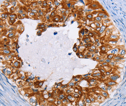 Immunohistochemistry of paraffin-embedded Human cervical cancer using CK-13 Polyclonal Antibody at dilution of 1:35