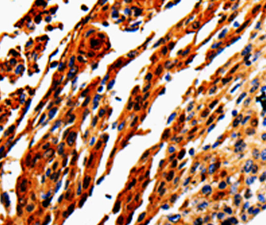 Immunohistochemistry of paraffin-embedded Human cervical cancer tissue using ADD1 Polyclonal Antibody at dilution 1:50