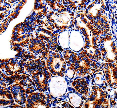 Immunohistochemistry of paraffin-embedded Human thyroid cancer using AFP Polyclonal Antibody at dilution of 1:40