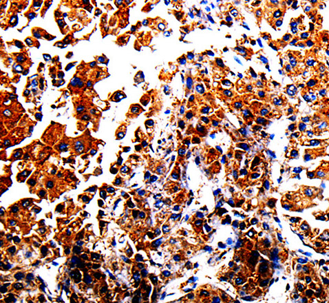 Immunohistochemistry of paraffin-embedded Human liver cancer using AFP Polyclonal Antibody at dilution of 1:40