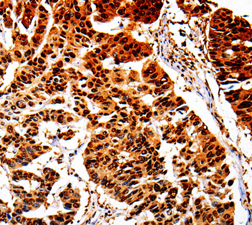 Immunohistochemistry of paraffin-embedded Human lung cancer  using AKR1B1 Polyclonal Antibody at dilution of 1:40