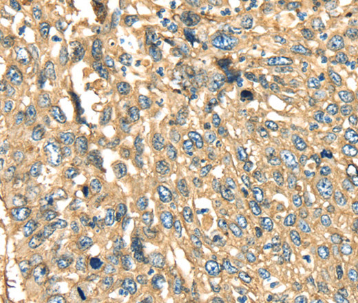 Immunohistochemistry of paraffin-embedded Human lung cancer using ANXA2 Polyclonal Antibody at dilution of 1:40