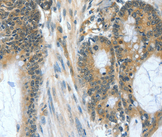 Immunohistochemistry of paraffin-embedded Human colon cancer tissue using BAD Polyclonal Antibody at dilution 1:60