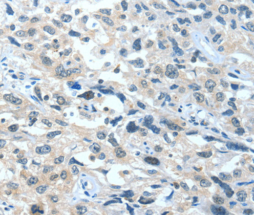 Immunohistochemistry of paraffin-embedded Human esophagus cancer tissue using BAD Polyclonal Antibody at dilution 1:60