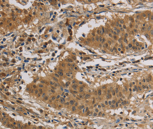 Immunohistochemistry of paraffin-embedded Human gastic cancer using CASP3 Polyclonal Antibody at dilution of 1:30