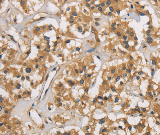 Immunohistochemistry of paraffin-embedded Human thyroid cancer using CASP3 Polyclonal Antibody at dilution of 1:30