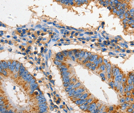 Immunohistochemistry of paraffin-embedded Human colon cancer using FAS Polyclonal Antibody at dilution of 1:60