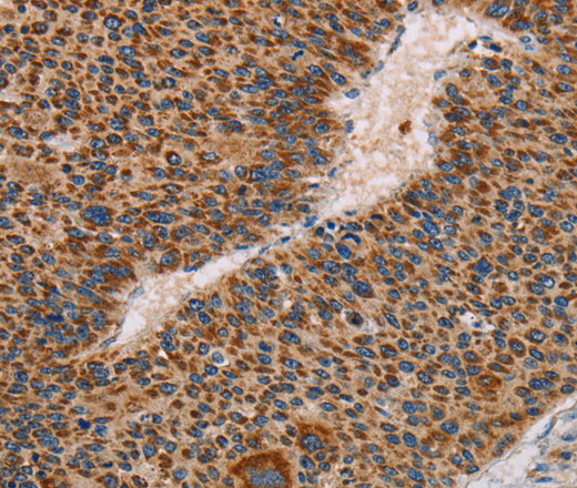 Immunohistochemistry of paraffin-embedded Human liver cancer using MMP1 Polyclonal Antibody at dilution of 1:60