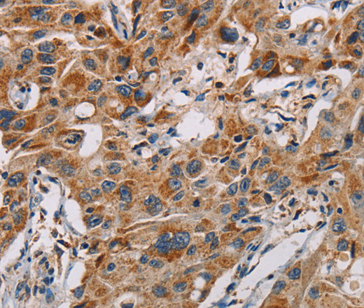 Immunohistochemistry of paraffin-embedded Human lung cancer using MMP1 Polyclonal Antibody at dilution of 1:60