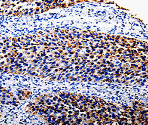 Immunohistochemistry of paraffin-embedded Human renal cancer tissue using COX10 Polyclonal Antibody at dilution 1:100