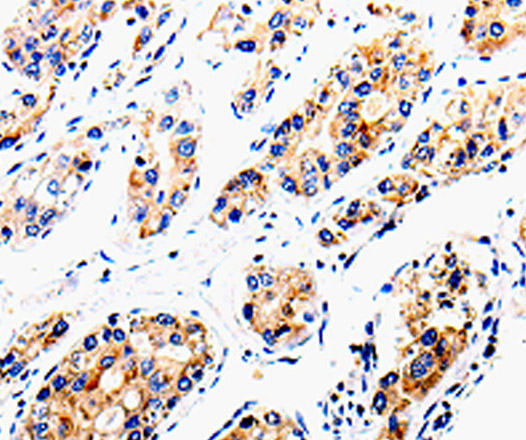 Immunohistochemistry of paraffin-embedded Human liver cancer tissue using COX16 Polyclonal Antibody at dilution 1:50