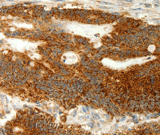 Immunohistochemistry of paraffin-embedded Human colon cancer using COX7B Polyclonal Antibody at dilution of 1:70