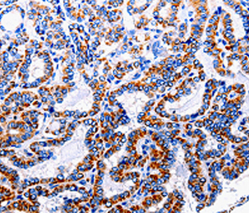 Immunohistochemistry of paraffin-embedded Human thyroid cancer tissue using NFκB-p105 Polyclonal Antibody at dilution 1:40