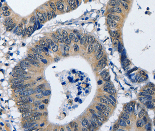 Immunohistochemistry of paraffin-embedded Human colon cancer using NFKBID Polyclonal Antibody at dilution of 1:40