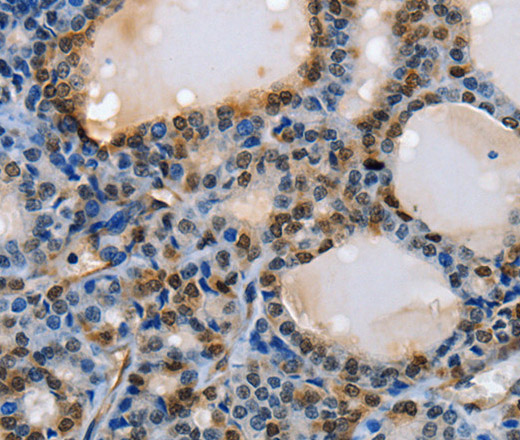 Immunohistochemistry of paraffin-embedded Human thyroid cancer using NFKBID Polyclonal Antibody at dilution of 1:40