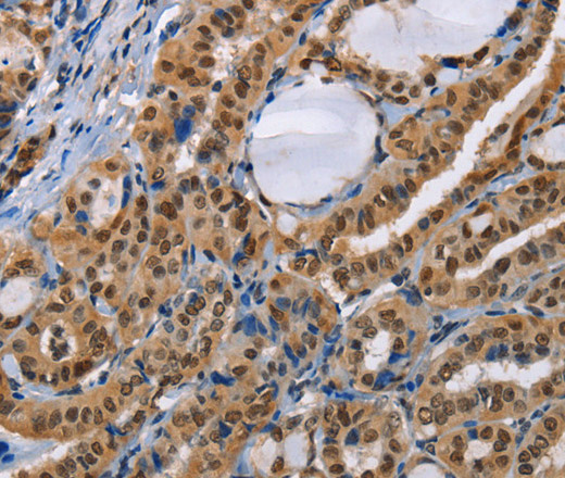 Immunohistochemistry of paraffin-embedded Human thyroid cancer using BAG1 Polyclonal Antibody at dilution of 1:40