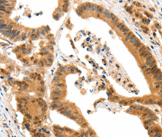 Immunohistochemistry of paraffin-embedded Human colon cancer tissue using HTR3A Polyclonal Antibody at dilution 1:50