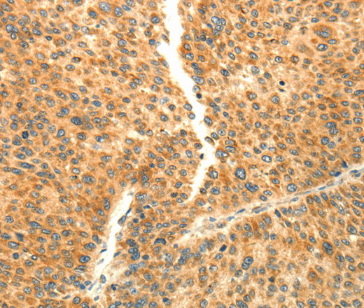 Immunohistochemistry of paraffin-embedded Human liver cancer using AARS2 Polyclonal Antibody at dilution of 1:80