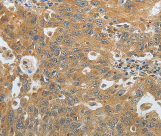 Immunohistochemistry of paraffin-embedded Human ovarian cancer using Amphiphysin I Polyclonal Antibody at dilution of 1:30