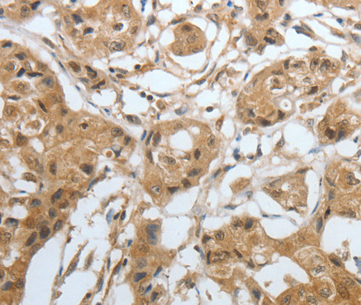 Immunohistochemistry of paraffin-embedded Human lung cancer using Amphiphysin I Polyclonal Antibody at dilution of 1:30