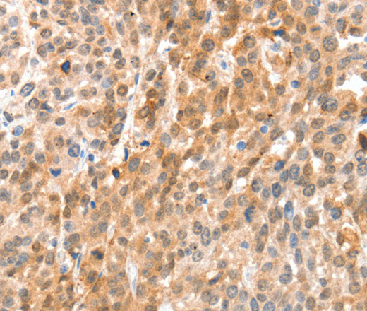 Immunohistochemistry of paraffin-embedded Human esophagus cancer using ANXA8 Polyclonal Antibody at dilution of 1:35