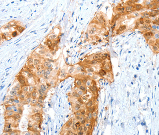 Immunohistochemistry of paraffin-embedded Human cervical cancer using ANXA8 Polyclonal Antibody at dilution of 1:35