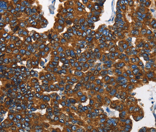 Immunohistochemistry of paraffin-embedded Human breast cancer tissue using CK-8 Polyclonal Antibody at dilution 1:40