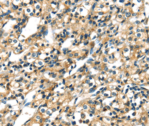 Immunohistochemistry of paraffin-embedded Human prostate cancer tissue using CK-17 Polyclonal Antibody at dilution 1:40