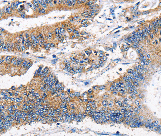 Immunohistochemistry of paraffin-embedded Human colon cancer tissue using APLNR Polyclonal Antibody at dilution 1:40