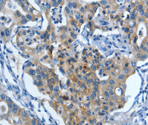 Immunohistochemistry of paraffin-embedded Human lung cancer tissue using MUC15 Polyclonal Antibody at dilution 1:50