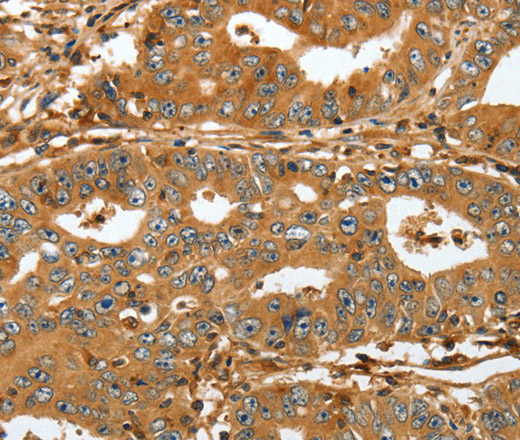 Immunohistochemistry of paraffin-embedded Human gastric cancer tissue using RAP1A Polyclonal Antibody at dilution 1:45