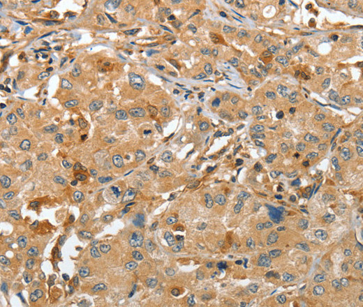 Immunohistochemistry of paraffin-embedded Human lung cancer tissue using RAP1A Polyclonal Antibody at dilution 1:45