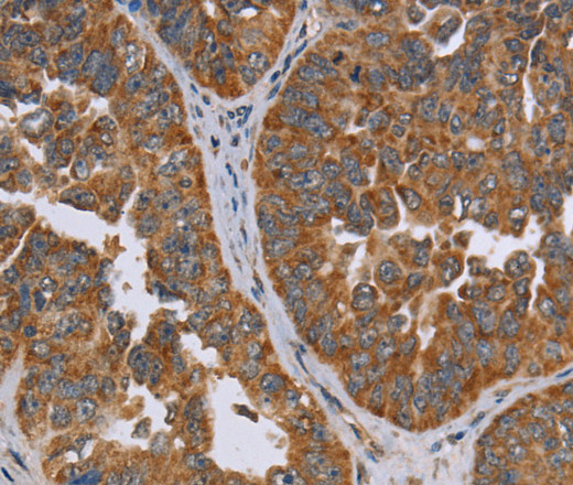 Immunohistochemistry of paraffin-embedded Human ovarian cancer tissue using ADAMTS15 Polyclonal Antibody at dilution 1:60