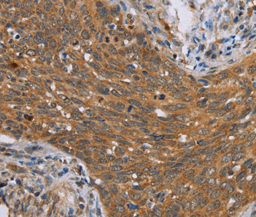 Immunohistochemistry of paraffin-embedded Human cervical cancer tissue using ADAMTS15 Polyclonal Antibody at dilution 1:60